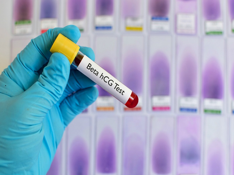 Beta HCG: desvendando o exame de gravidez