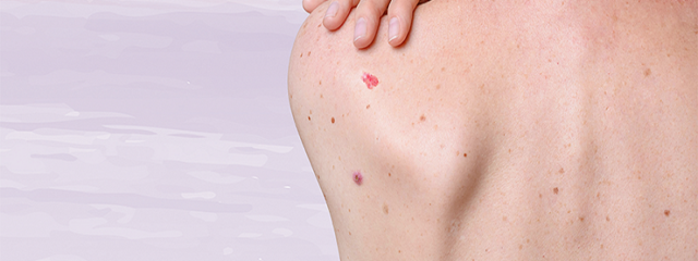 Câncer de pele: conheça os sintomas, o tratamento e a prevenção da doença