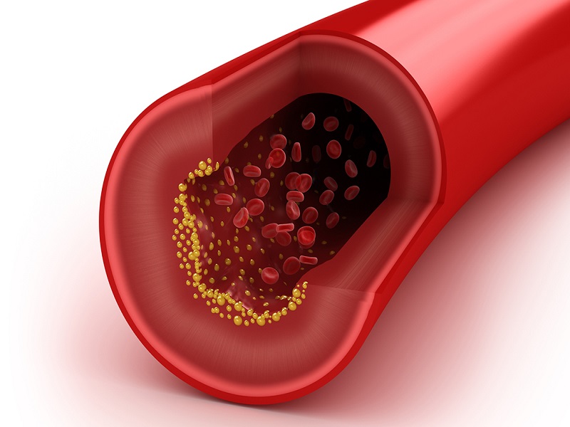 Você conhece as consequências do colesterol alto?